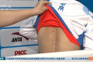 石智勇：我现在背上全部都是针眼，还一直控制不住疼痛